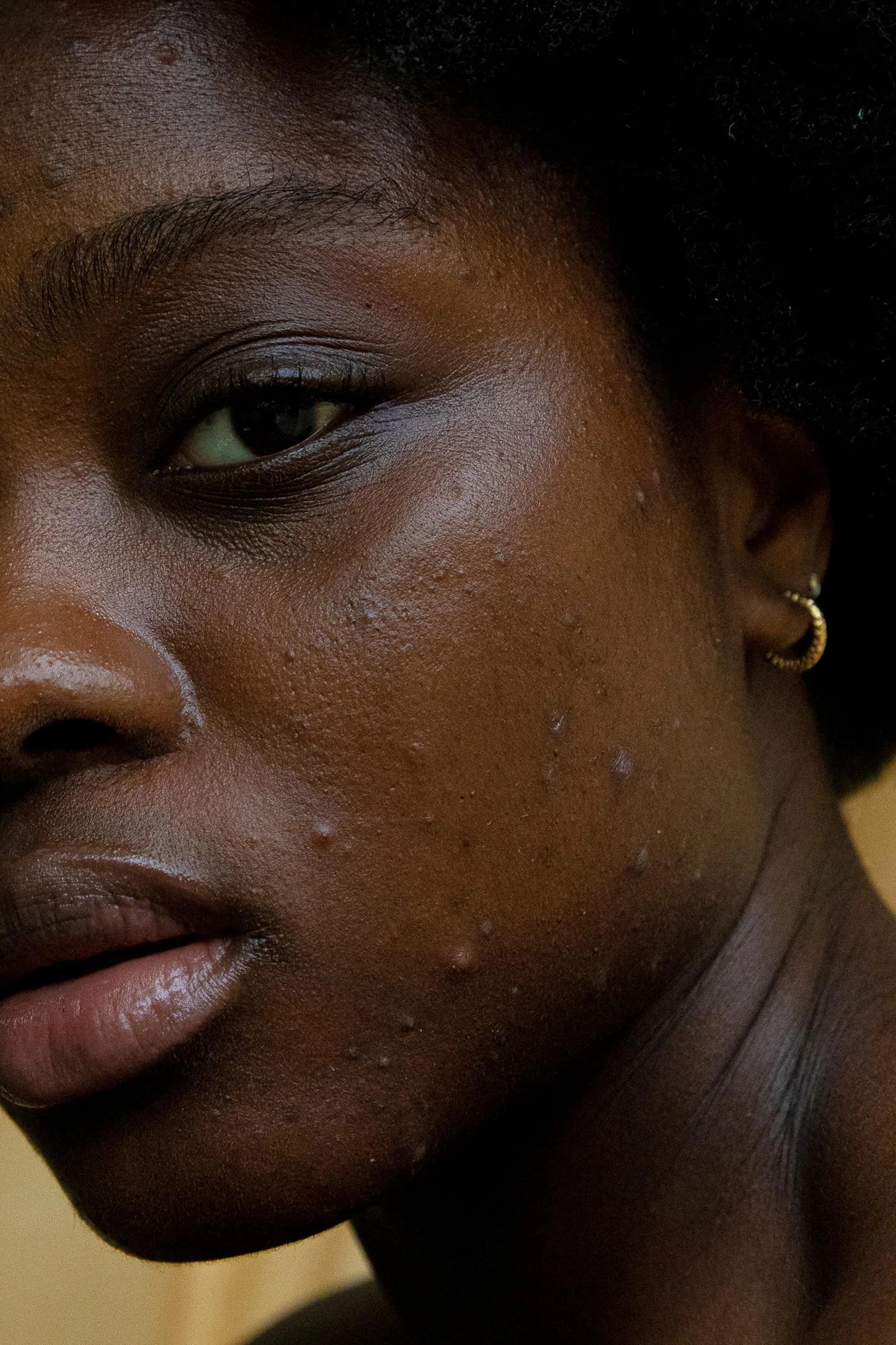 black woman with hyperpigmented skin